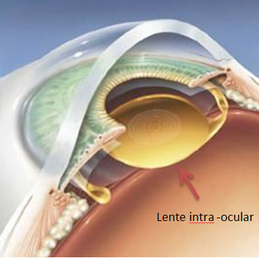 Lente intra ocular