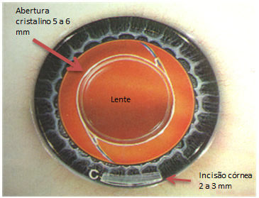 Técnica para Cirurgia da Catarata